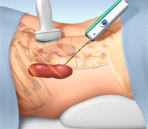 Second Opinion Consultation for a Biopsy Obtained with a Needle